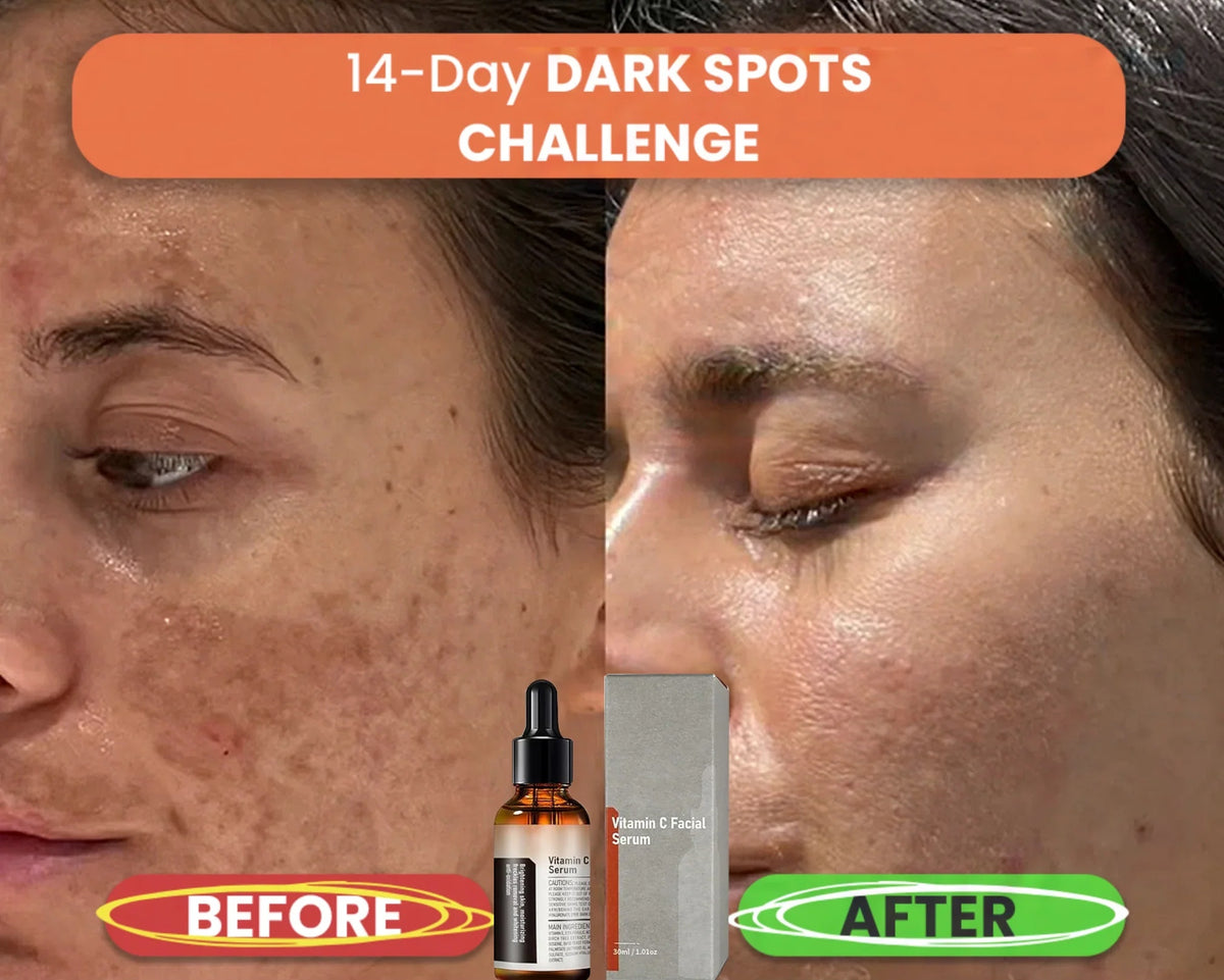 【Dermatologist-Recommended】 VC Spot-Correction & Whitening Cream Set-50%OFF