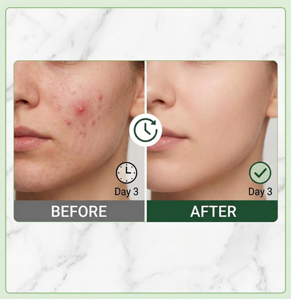 Double Action Set - Pimple Warrior Acne Drying Lotion Duo